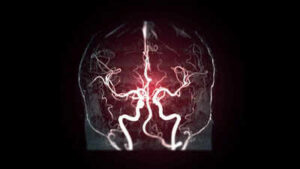 Cerebral Angiography: 7 silent warning signs that may mean you need a Cerebral Angiography
