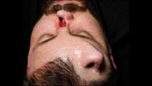 Iraqi surgeon grows nose on patient’s forehead in rare reconstruction surgery to correct facial damage in high-voltage electrical accident